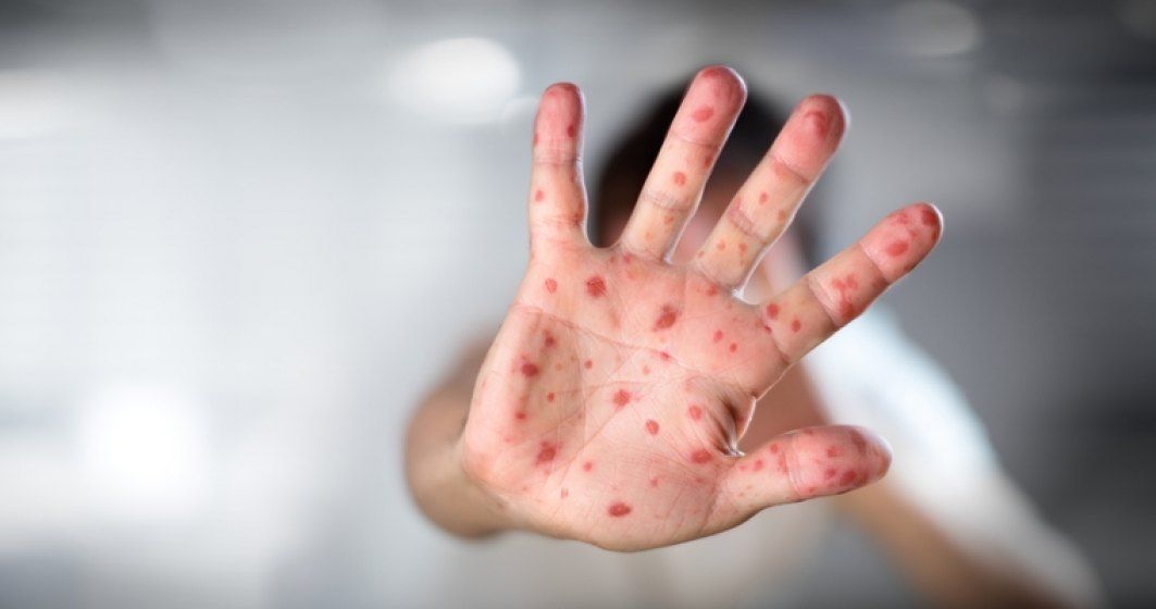 Bebeluș nevaccinat, decedat din cauza rujeolei