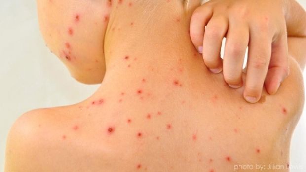 Două noi cazuri de rujeolă, descoperite în Iaşi!