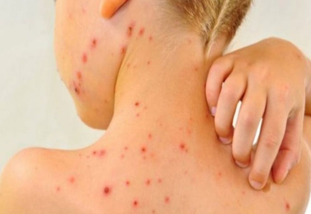 Avertisment al medicilor: Noi cazuri de rujeolă la Iași!