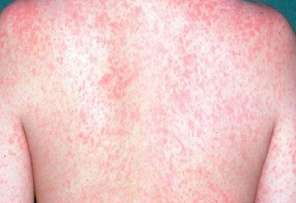 Toată lumea se teme de coronavirus, dar o altă boală face victime! În România au murit deja 64 de persoane