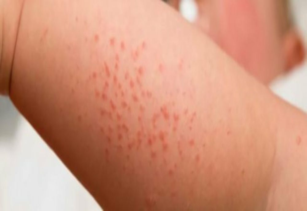 Fetiţă cu scarlatină, internată la Infecţioase