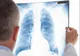 Crește alarmantă a numărul cazurilor de TUBERCULOZĂ la copii! Semnal de alarmă al medicilor: SIMPTOMELE care ar trebui să ne dea de gândit