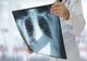 Alertă epidemiologică: Focar de tuberculoză la o grădiniţă din Iași
